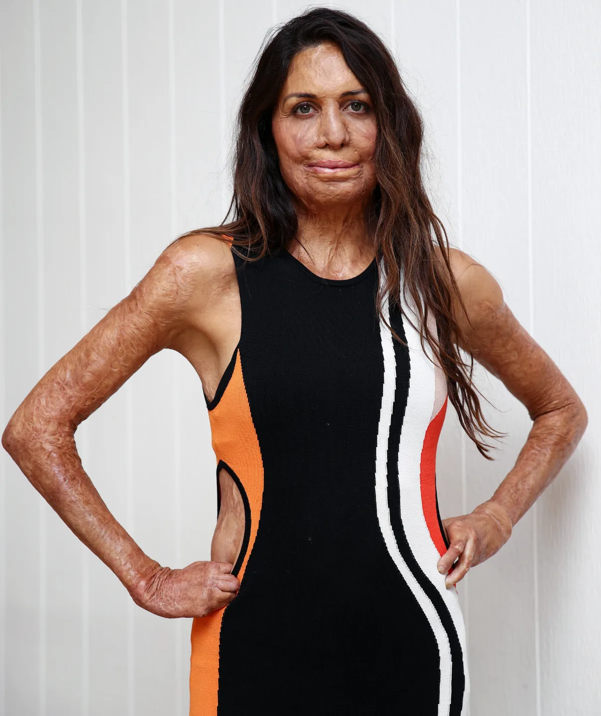 Turia Pitt shares update after recent health scare