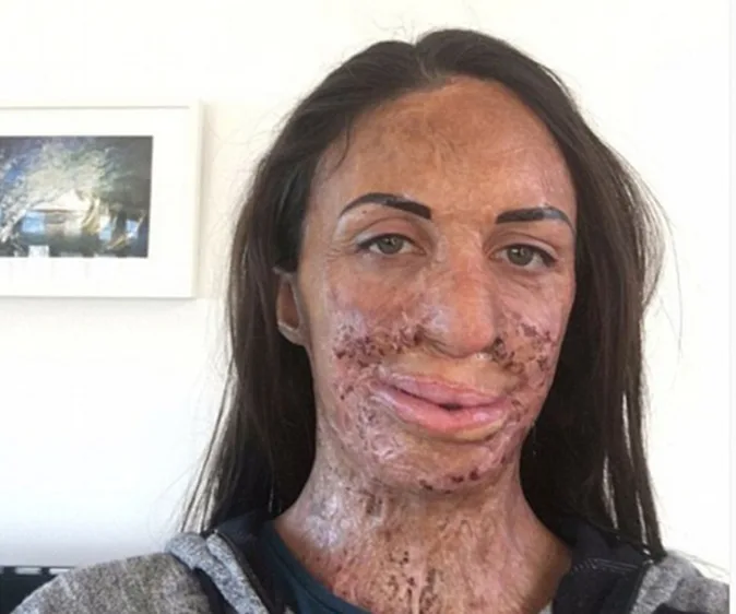 Brave Turia Pitt reveals surgery struggle